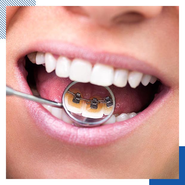Your Lingual Braces Provider in Sherman and Bonham, Texas